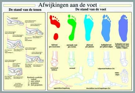Poster afwijkingen van de voet 40 x 60, geplastificeerd
